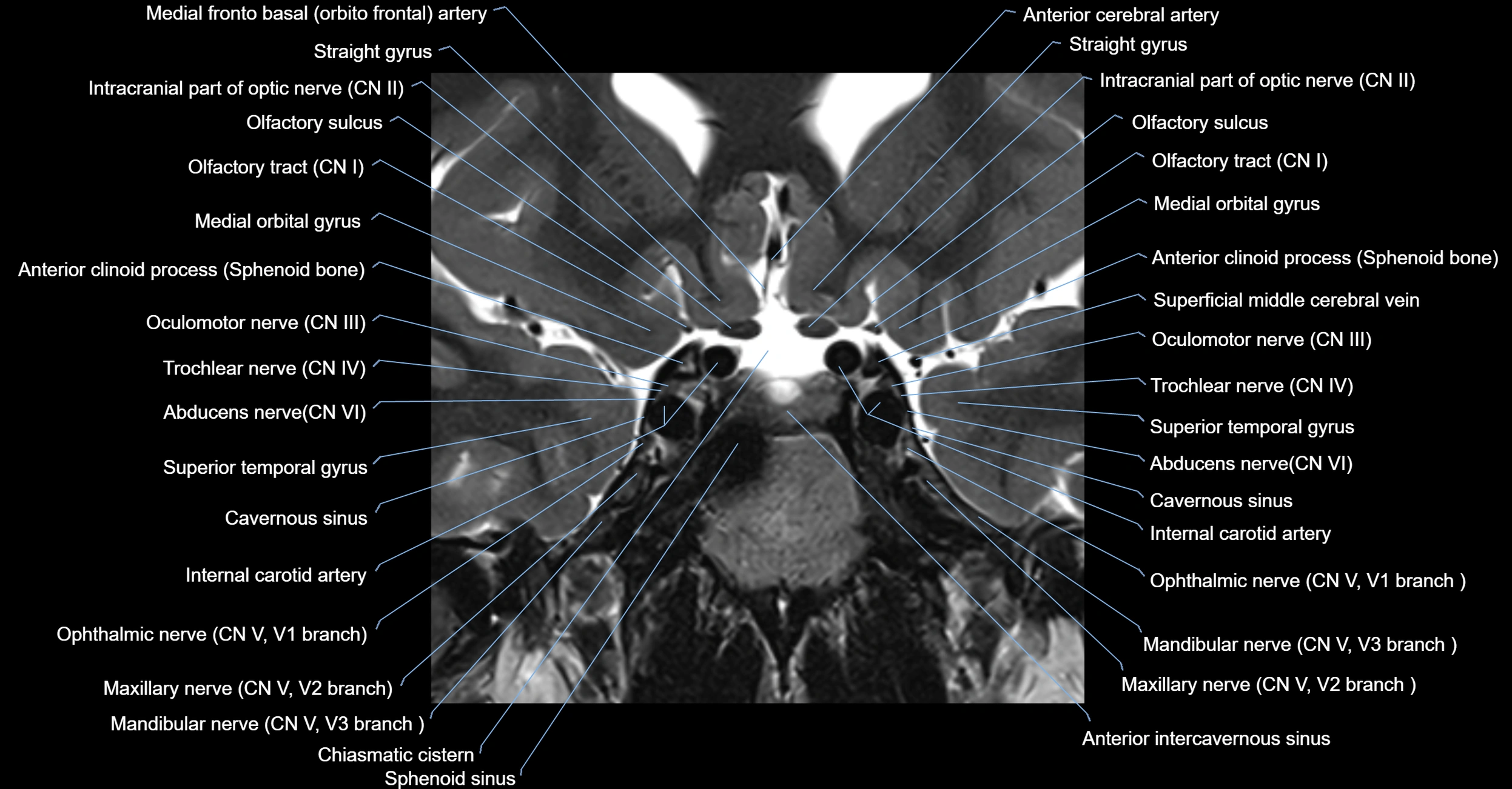 MRI cavernous sinus coronal cross sectional 3T anatomy image-img-00001-00009.webp